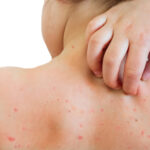 Chickenpox Parties Health and Environment